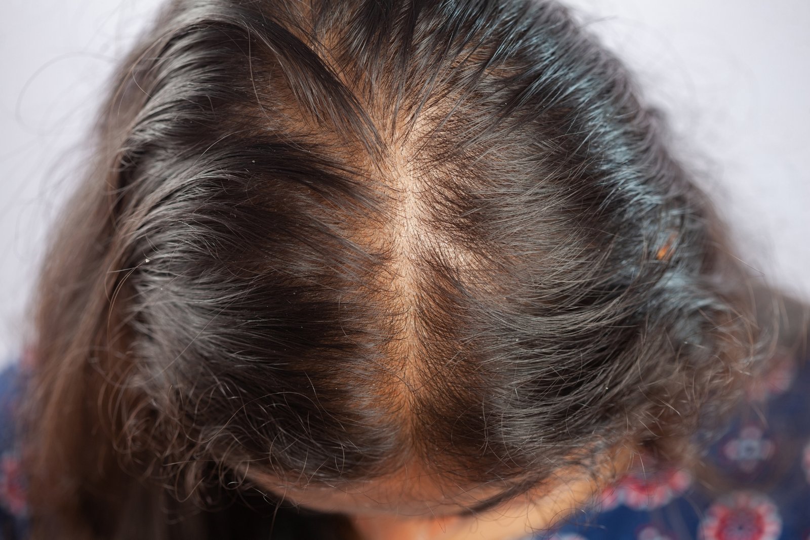 Sanfte Pflege bei trockener und empfindlicher Kopfhaut - Was ist Haartherapie